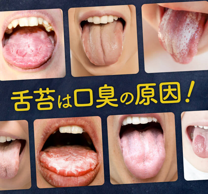 舌苔は口臭の原因！